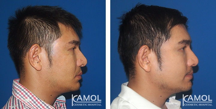 Before and After Jaw Augmentation