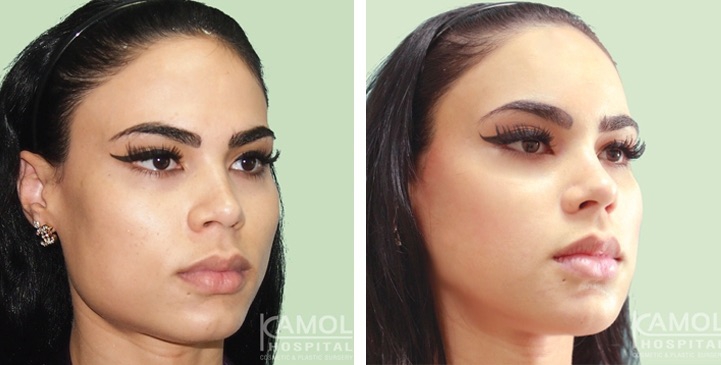 Before and After Jaw Reduction