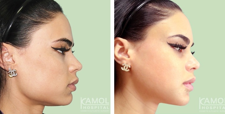 Jaw Reduction