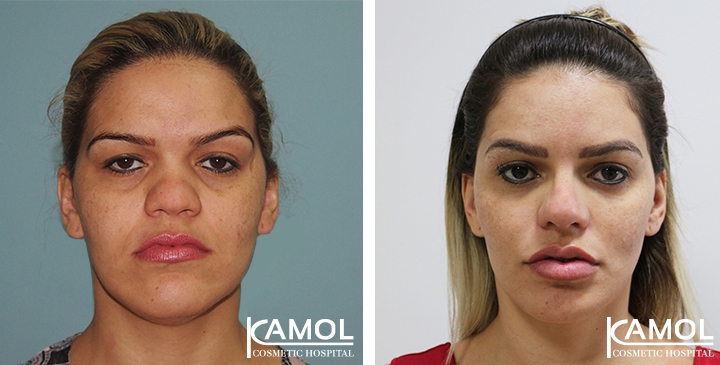 Before and After Jaw Reduction Surgery