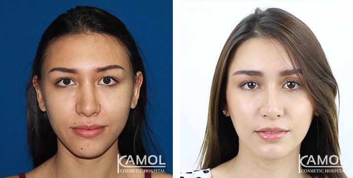 Before and After Jaw Reduction Surgery