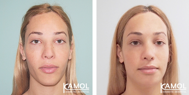 Before and After Forehead Compression
