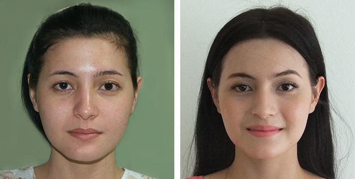 Before and After Jaw to Chin Reduction Surgery