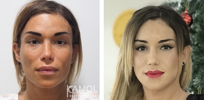 Before and After Jaw Reduction