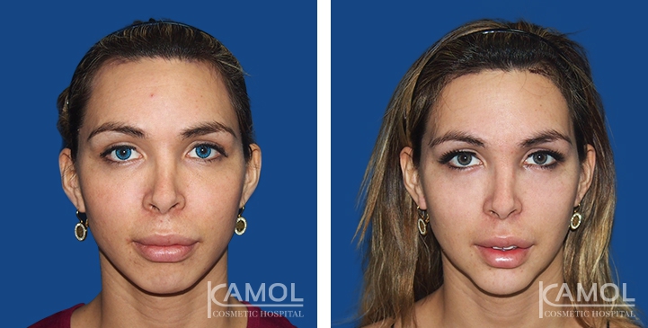 Before and After Forehead Compression, Forehead Contouring Surgery