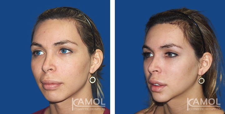 Before and After Forehead Compression, Forehead Contouring Surgery