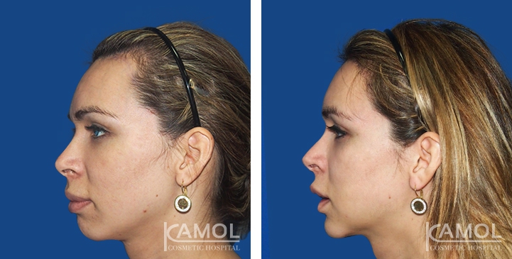 Before and After Forehead Compression, Forehead Contouring Surgery