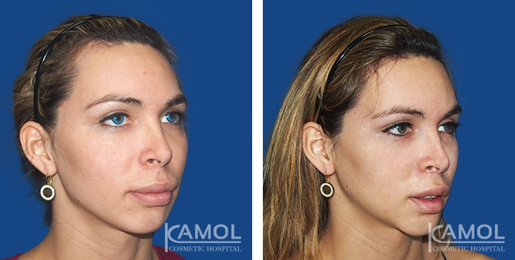 Before and After Forehead Compression, Forehead Contouring Surgery