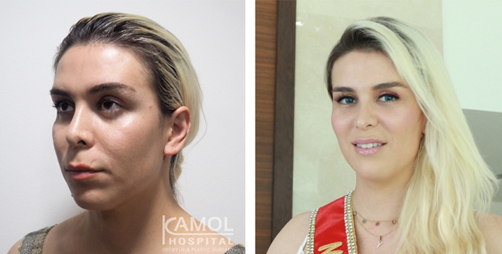 Before and After 1 month surgery, Forehead Augmentation, Forehead Contouring, Forehead Shaving, Jaw to Chin Reduction