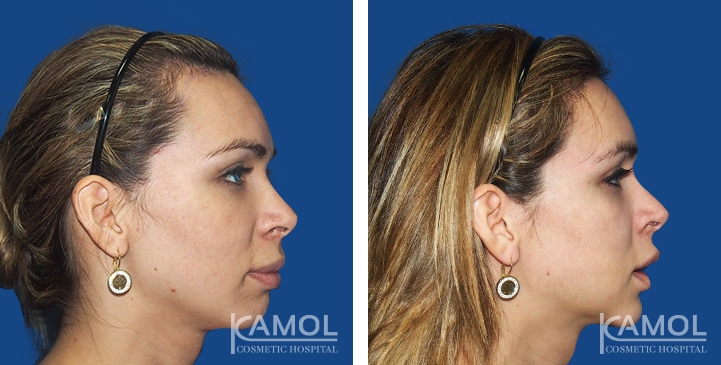 Before and After Forehead Compression, Forehead Contouring Surgery