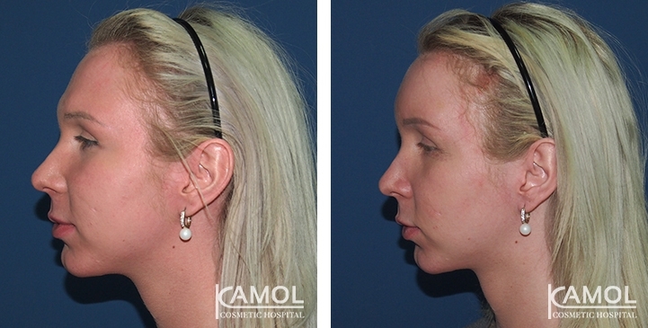 Before and After, Forehead Shaving and Forehead Augmentation