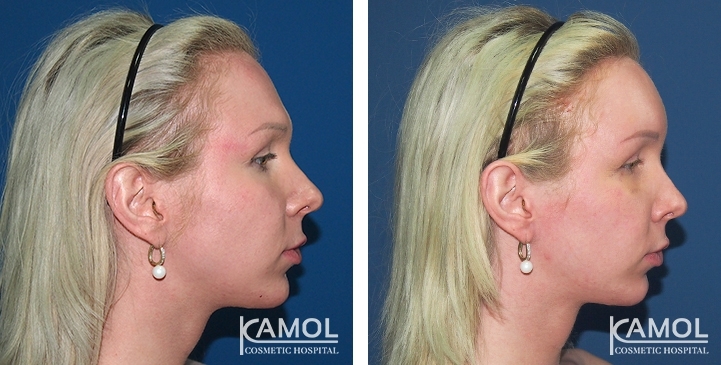 Before and After, Forehead Shaving and Forehead Augmentation