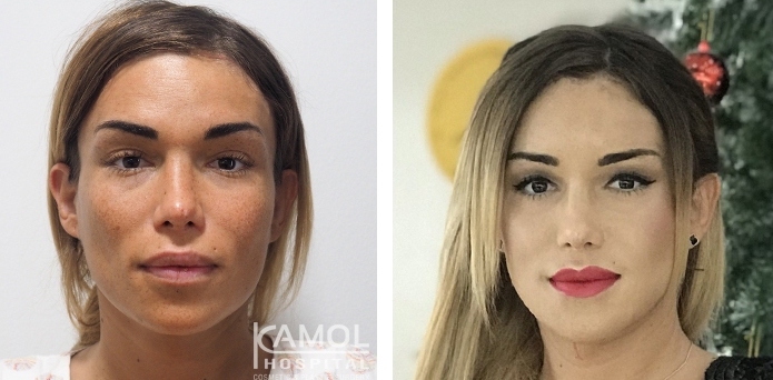 Before and After Forehead shaving and Forehead Augmentation