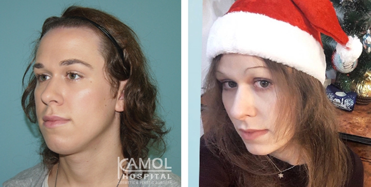Before and After 1 month surgery, Facial Feminization Surgery, FFS,Forehead Shaving,Rhinoplasty, Hair Line Lowering, Chin Forward Sliding