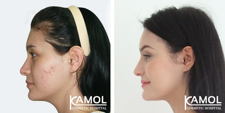 Forehead Augmentation