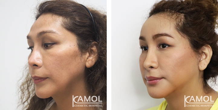 Before and After Forehead Augmentation