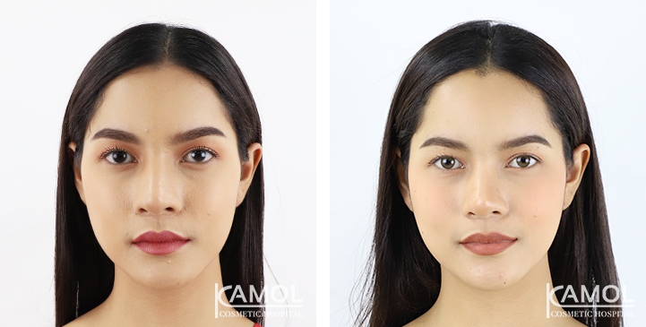 Before and After Forehead Augmentation