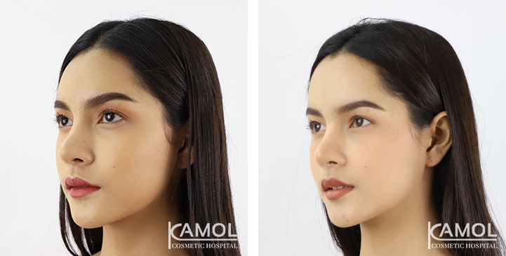 Before and After Forehead Augmentation