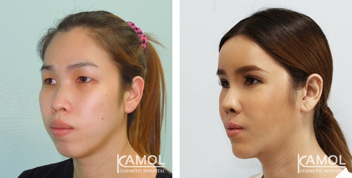 Before and After Forehead Augmentation