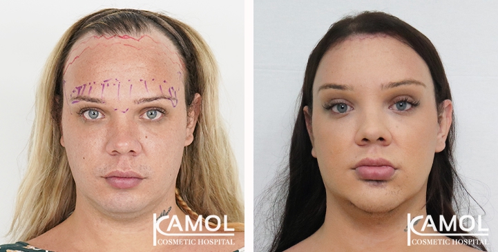 Hairline lowering, Forehead shaving, Forehead contouring type 3, Facial liposuction, Under chin liposuction