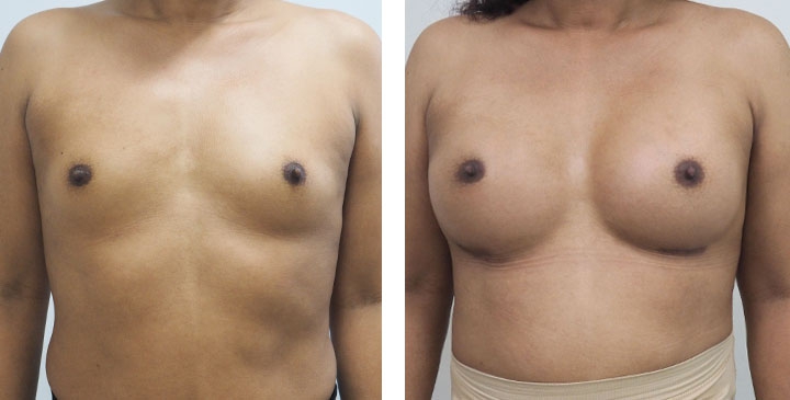 Male to Female Breast Surgery