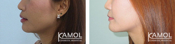 Upper Lip Lift