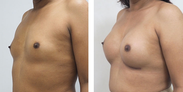 Male to Female Breast Surgery