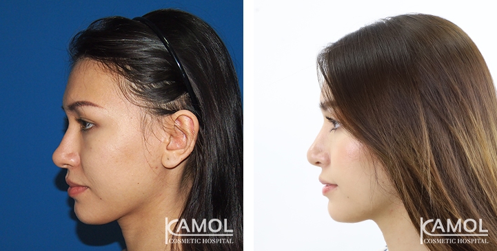 Before and After Cheekbone Reduction / Zygoma reduction