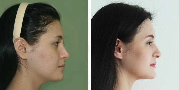 Before and After Cheekbone Reduction / Zygoma reduction