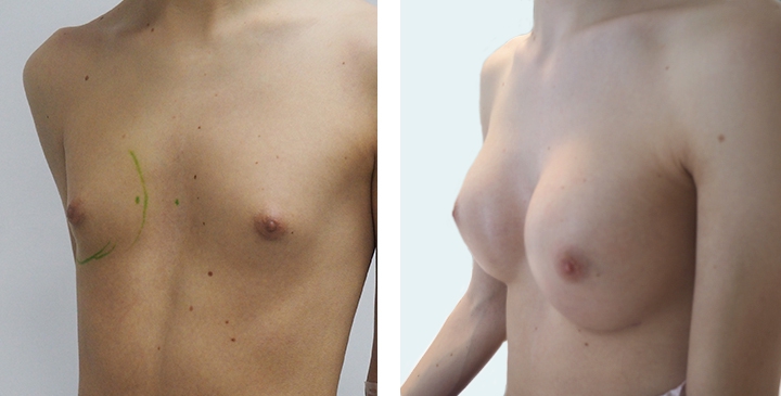 Male to Female Breast Surgery