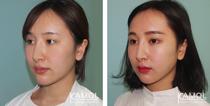 Before and After Cheekbone Reduction / Zygoma reduction