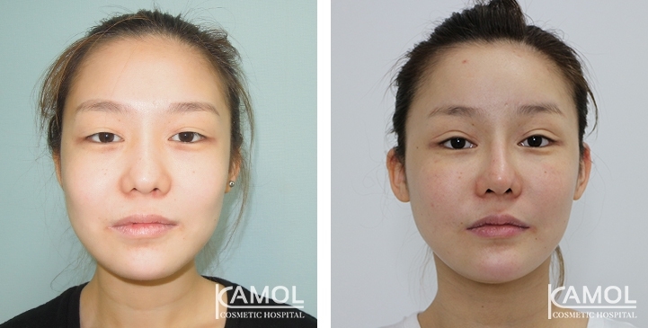 Before and After Cheekbone Reduction / Zygoma reduction