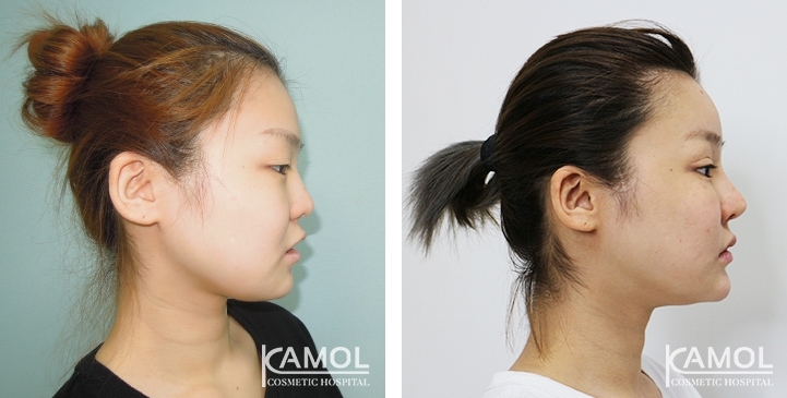 Before and After Cheekbone Reduction / Zygoma reduction