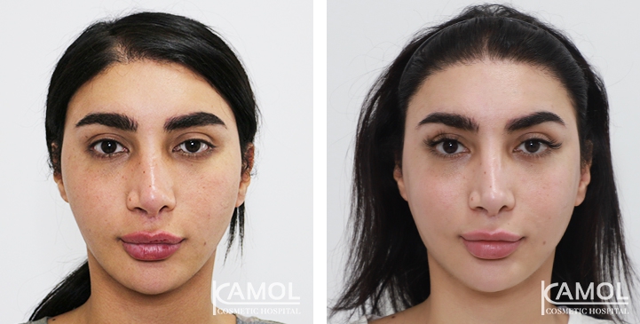 Cheekbone reduction