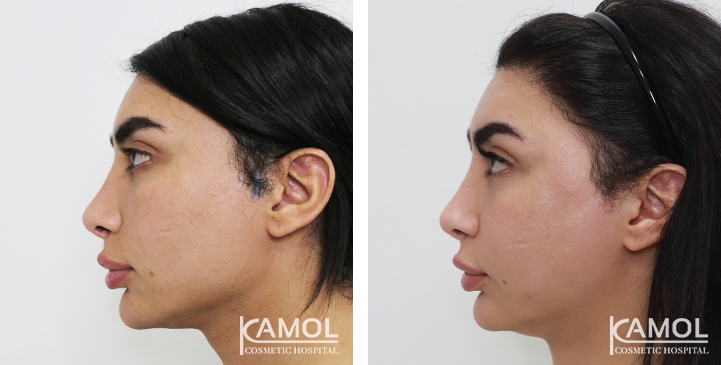 Cheekbone reduction