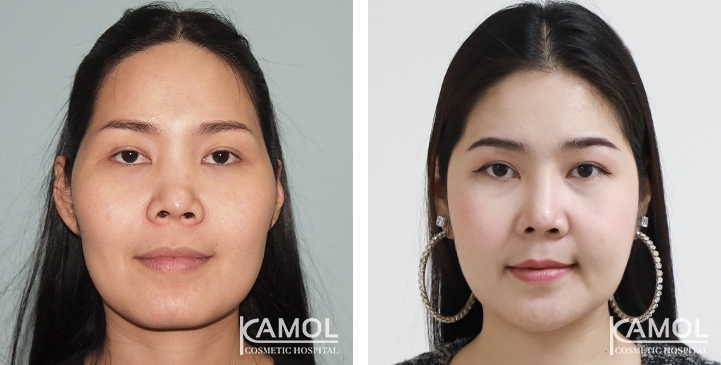 Before and After Cheekbone Reduction / Zygoma reduction