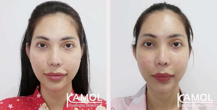 Before and After Cheekbone Augmentation