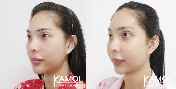 Before and After Cheekbone Augmentation