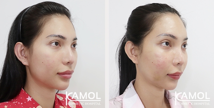 Before and After Cheekbone Augmentation