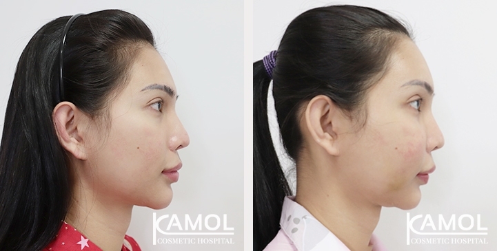 Before and After Cheekbone Augmentation