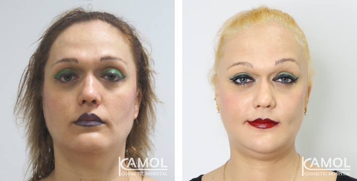 Before and After Cheekbone Augmentation