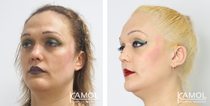 Before and After Cheekbone Augmentation