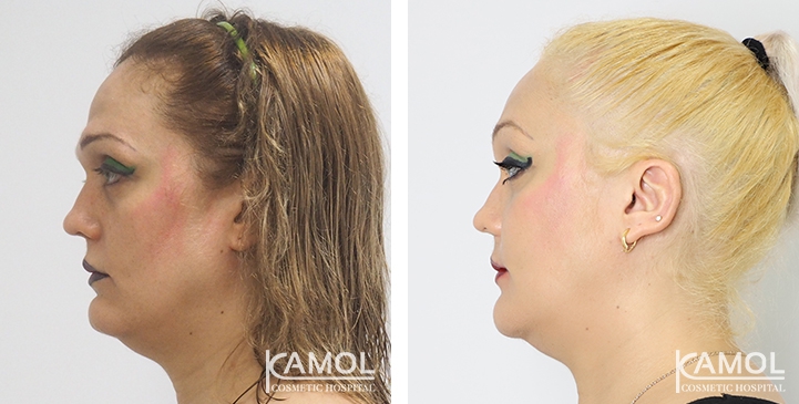 Before and After Cheekbone Augmentation