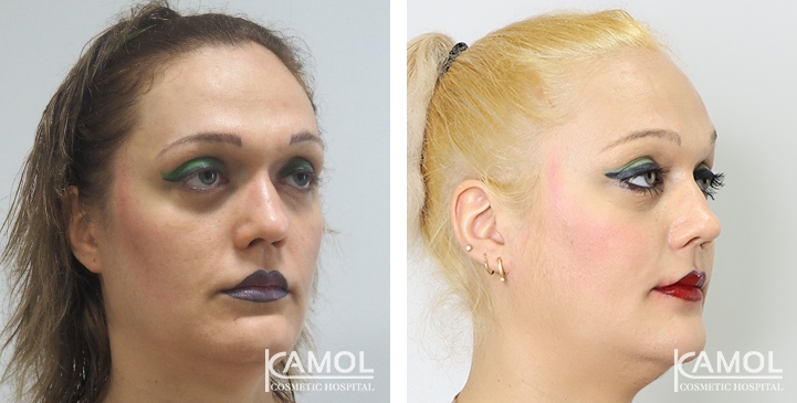 Before and After Cheekbone Augmentation