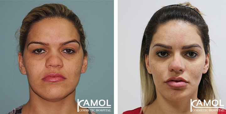 Before and After Cheekbone Augmentation
