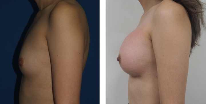 Male to Female Breast Surgery