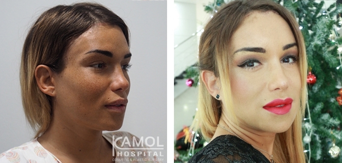 Before and After Cheekbone Augmentation