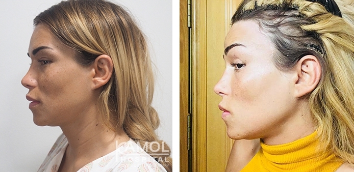 Before and After Cheekbone Augmentation