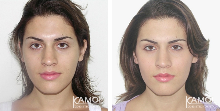 Before and After Cheekbone Augmentation