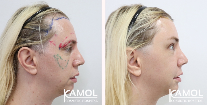 Cheek Augmentation,Hairline lowering,Forehead Lift,Forehead compression,Eye Brow Lift